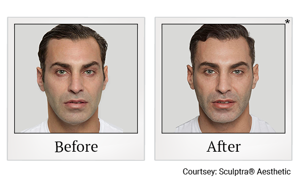 Before and After Photo 1 of Sculptra® treatment at SF Bay Cosmetic Surgery Medical Group in San Ramon, Pleasanton, San Jose, and Oakland
