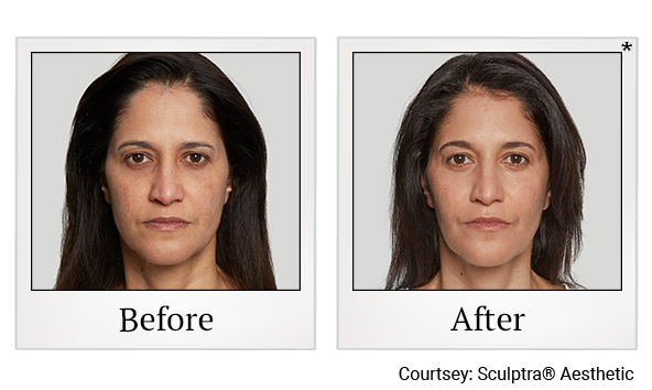 Before and After Photo 10 of Sculptra® treatment at SF Bay Cosmetic Surgery Medical Group in San Ramon