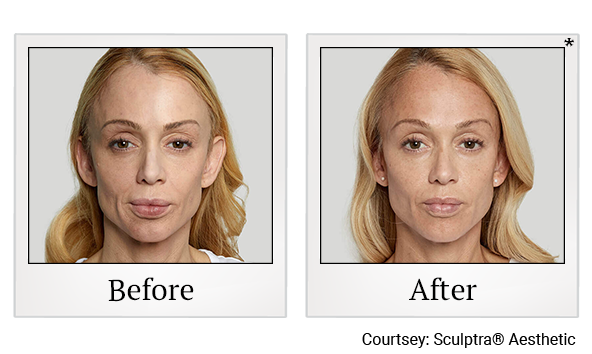 Before and After Photo 2 of Sculptra® treatment at SF Bay Cosmetic Surgery Medical Group in San Ramon, Pleasanton, San Jose, and Oakland