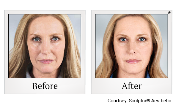 Before and After Photo 3 of Sculptra® treatment at SF Bay Cosmetic Surgery Medical Group in San Ramon