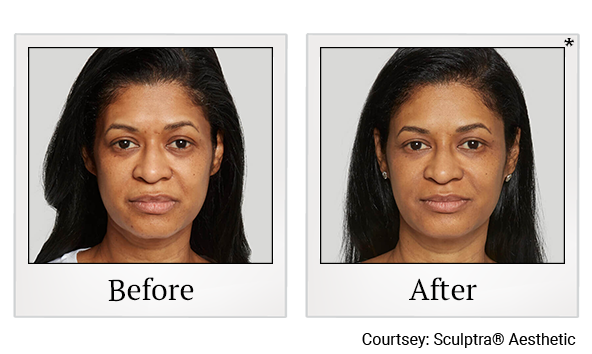 Before and After Photo 4 of Sculptra® treatment at SF Bay Cosmetic Surgery Medical Group in San Ramon