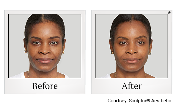 Before and After Photo 6 of Sculptra® treatment at SF Bay Cosmetic Surgery Medical Group in San Ramon, Pleasanton, San Jose, and Oakland