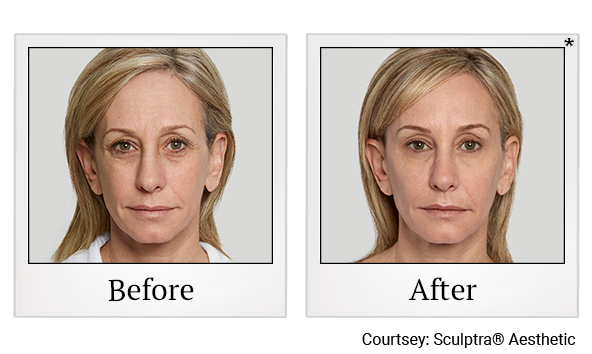 Before and After Photo 7 of Sculptra® treatment at SF Bay Cosmetic Surgery Medical Group in San Ramon