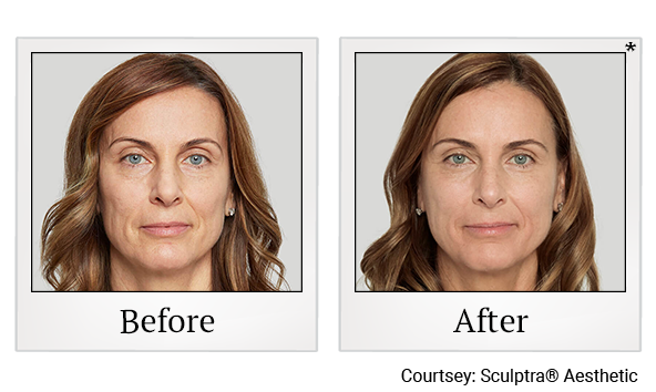 Before and After Photo 8 of Sculptra® treatment at SF Bay Cosmetic Surgery Medical Group in San Ramon