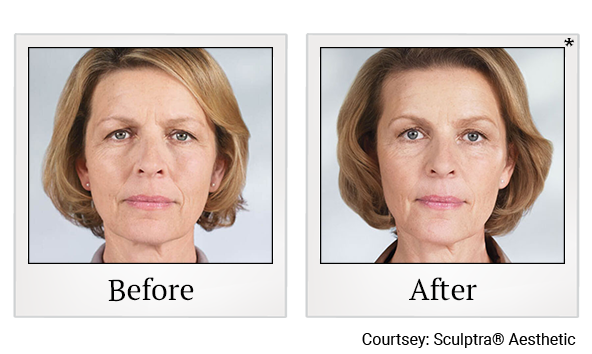 Before and After Photo 9 of Sculptra® treatment at SF Bay Cosmetic Surgery Medical Group in San Ramon