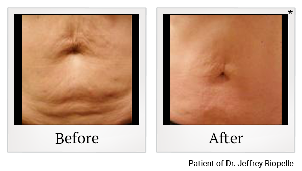 Before and After Photo 9 of Thermage® treatment at SF Bay Cosmetic Surgery Medical Group in San Ramon
