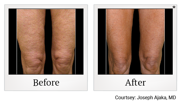 Before and After Photo 2 of Thermage® Body treatment at SF Bay Cosmetic Surgery Medical Group in San Ramon