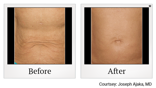 Before and After Photo 3 of Thermage® Body treatment at SF Bay Cosmetic Surgery Medical Group in San Ramon