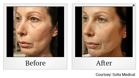 Before and After Photo 1 of Thermage® treatment at SF Bay Cosmetic Surgery Medical Group in San Ramon