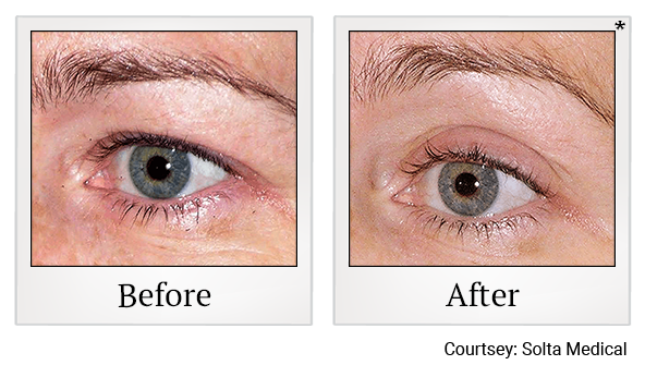 Before and After Photo 3 of Thermage® treatment at SF Bay Cosmetic Surgery Medical Group in San Ramon