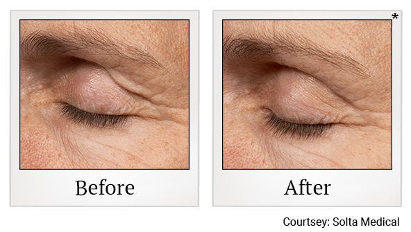 Before and After Photo 4 of Thermage® treatment at SF Bay Cosmetic Surgery Medical Group in San Ramon