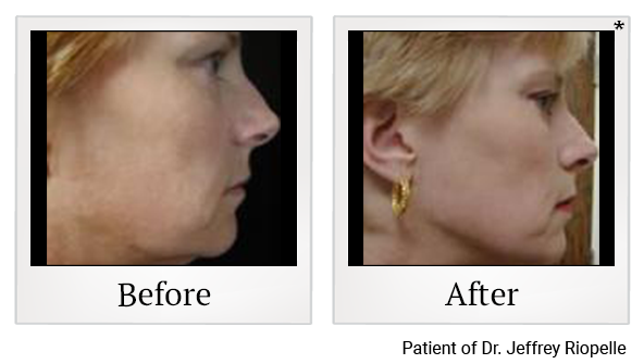 Before and After Photo 5 of Thermage® Face treatment at SF Bay Cosmetic Surgery Medical Group in San Ramon, Pleasanton, San Jose, and Oakland
