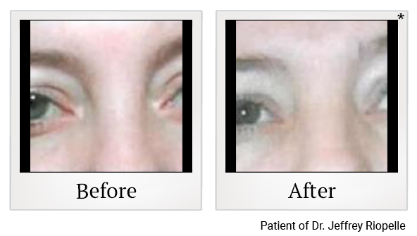 Before and After Photo 7 of Thermage® treatment at SF Bay Cosmetic Surgery Medical Group in San Ramon
