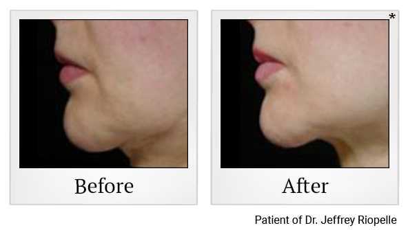 Before and After Photo 8 of Thermage® treatment at SF Bay Cosmetic Surgery Medical Group in San Ramon