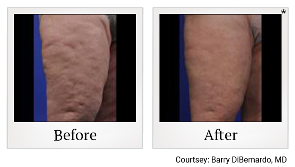 Before and After Photo 1 of ThermiSmooth® Body treatment at SF Bay Cosmetic Surgery Medical Group in San Ramon