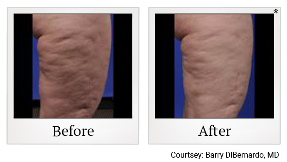 Before and After Photo 2 of ThermiSmooth® Body treatment at SF Bay Cosmetic Surgery Medical Group in San Ramon