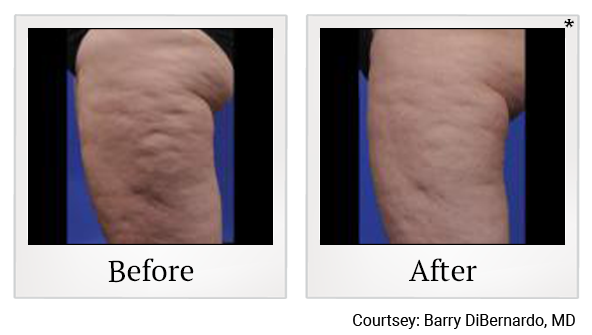 Before and After Photo 7 of ThermiSmooth® treatment at SF Bay Cosmetic Surgery Medical Group in San Ramon