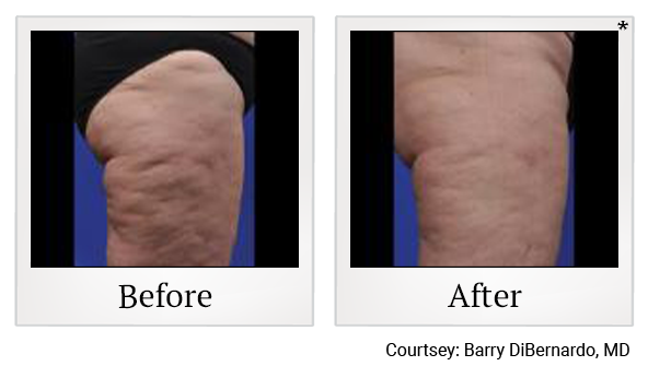 Before and After Photo 4 of ThermiSmooth® Body treatment at SF Bay Cosmetic Surgery Medical Group in San Ramon