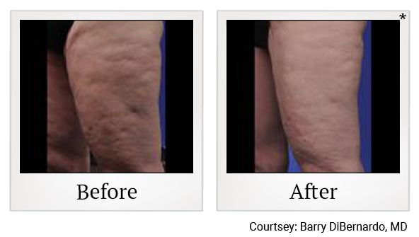 Before and After Photo 5 of ThermiSmooth® Body treatment at SF Bay Cosmetic Surgery Medical Group in San Ramon