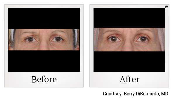 Before and After Photo 1 of ThermiSmooth® treatment at SF Bay Cosmetic Surgery Medical Group in San Ramon