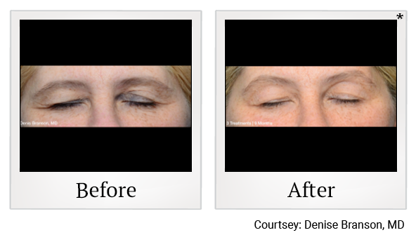 Before and After Photo 2 of ThermiSmooth® Face treatment at SF Bay Cosmetic Surgery Medical Group in San Ramon, Pleasanton, San Jose, and Oakland