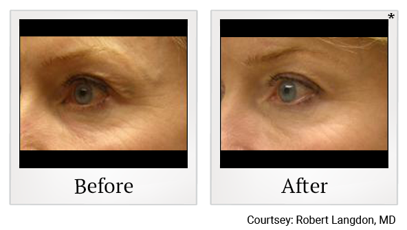 Before and After Photo 4 of ThermiSmooth® treatment at SF Bay Cosmetic Surgery Medical Group in San Ramon