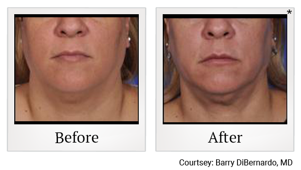 Before and After Photo 1 of Thermitight® treatment at SF Bay Cosmetic Surgery Medical Group in San Ramon