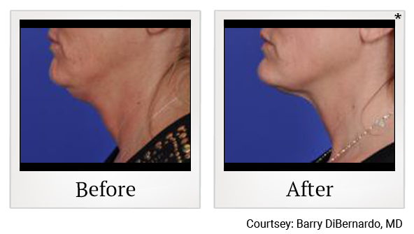 Before and After Photo 2 of Thermitight® treatment at SF Bay Cosmetic Surgery Medical Group in San Ramon