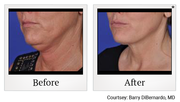 Before and After Photo 3 of Thermitight® treatment at SF Bay Cosmetic Surgery Medical Group in San Ramon
