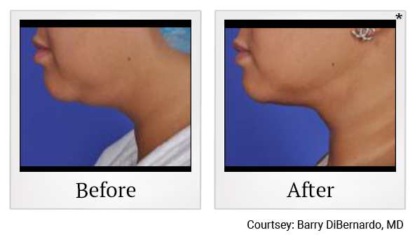 Before and After Photo 4 of Thermitight® treatment at SF Bay Cosmetic Surgery Medical Group in San Ramon
