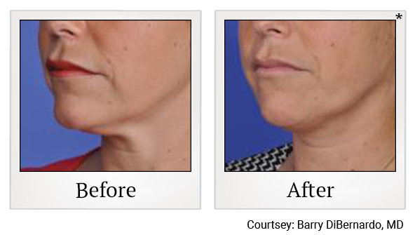 Before and After Photo 5 of Thermitight® treatment at SF Bay Cosmetic Surgery Medical Group in San Ramon