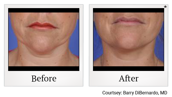 Before and After Photo 6 of Thermitight® treatment at SF Bay Cosmetic Surgery Medical Group in San Ramon
