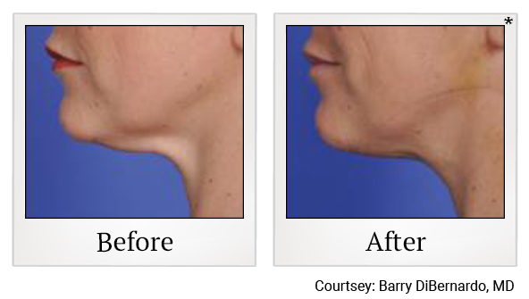 Before and After Photo 7 of Thermitight® treatment at SF Bay Cosmetic Surgery Medical Group in San Ramon