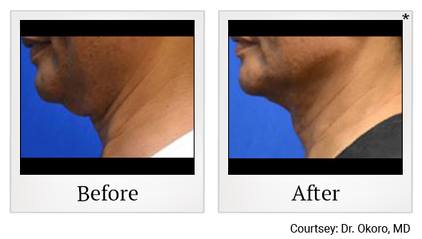 Before and After Photo 9 of Thermitight® treatment at SF Bay Cosmetic Surgery Medical Group in San Ramon