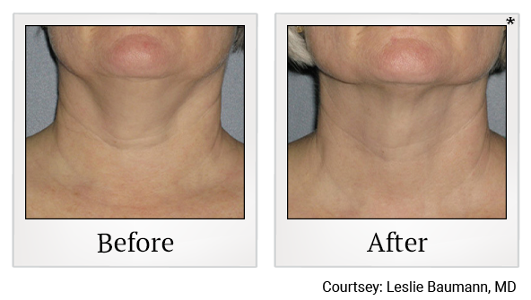 Before and After Photo 1 of Ultherapy treatment at SF Bay Cosmetic Surgery Medical Group in San Ramon