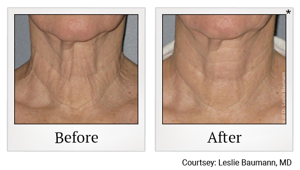 Before and After Photo 10 of Ultherapy treatment at SF Bay Cosmetic Surgery Medical Group in San Ramon