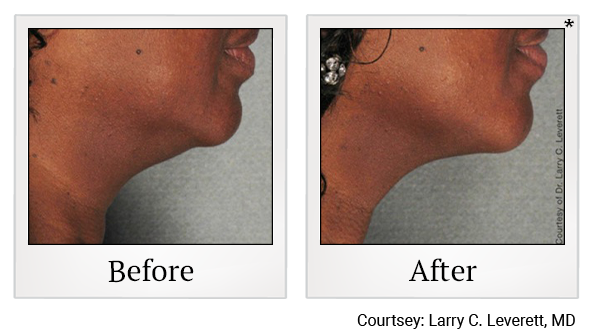 Before and After Photo 11 of Ultherapy treatment at SF Bay Cosmetic Surgery Medical Group in San Ramon