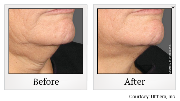 Before and After Photo 12 of Ultherapy treatment at SF Bay Cosmetic Surgery Medical Group in San Ramon