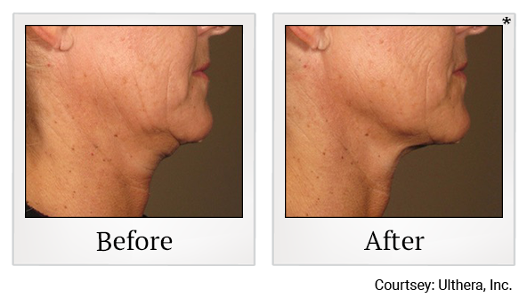 Before and After Photo 13 of Ultherapy treatment at SF Bay Cosmetic Surgery Medical Group in San Ramon