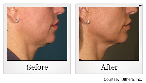 Before and After Photo 14 of Ultherapy treatment at SF Bay Cosmetic Surgery Medical Group in San Ramon