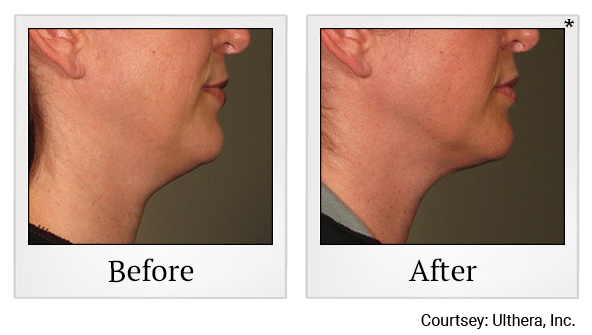 Before and After Photo 15 of Ultherapy treatment at SF Bay Cosmetic Surgery Medical Group in San Ramon