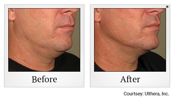 Before and After Photo 17 of Ultherapy treatment at SF Bay Cosmetic Surgery Medical Group in San Ramon