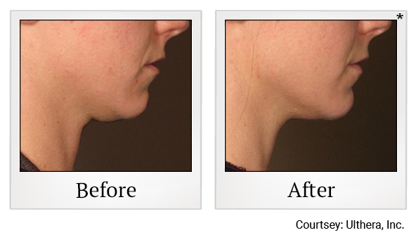Before and After Photo 19 of Ultherapy treatment at SF Bay Cosmetic Surgery Medical Group in San Ramon