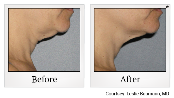 Before and After Photo 2 of Ultherapy treatment at SF Bay Cosmetic Surgery Medical Group in San Ramon
