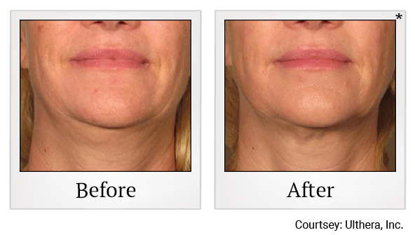 Before and After Photo 20 of Ultherapy treatment at SF Bay Cosmetic Surgery Medical Group in San Ramon