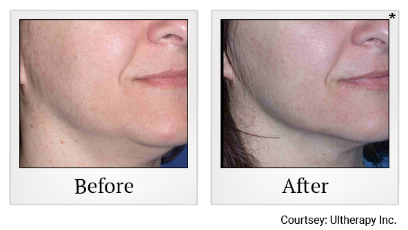 Before and After Photo 22 of Ultherapy treatment at SF Bay Cosmetic Surgery Medical Group in San Ramon
