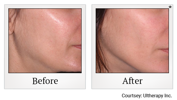 Before and After Photo 23 of Ultherapy treatment at SF Bay Cosmetic Surgery Medical Group in San Ramon