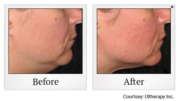 Before and After Photo 25 of Ultherapy treatment at SF Bay Cosmetic Surgery Medical Group in San Ramon