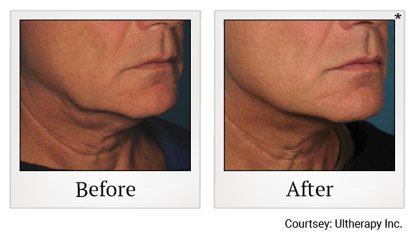 Before and After Photo 26 of Ultherapy treatment at SF Bay Cosmetic Surgery Medical Group in San Ramon