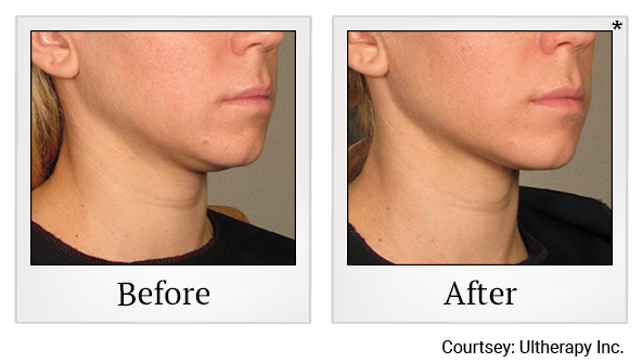 Before and After Photo 27 of Ultherapy treatment at SF Bay Cosmetic Surgery Medical Group in San Ramon